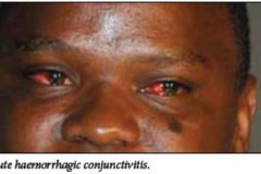 Cameroon’s ongoing battle with Conjunctivitis